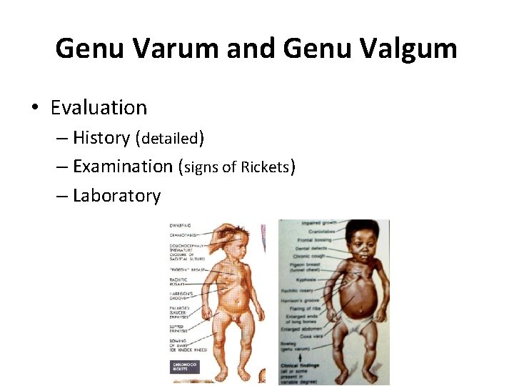 Genu Varum and Genu Valgum • Evaluation – History (detailed) – Examination (signs of