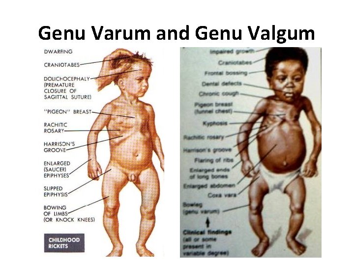 Genu Varum and Genu Valgum 