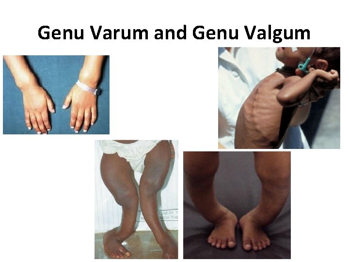 Genu Varum and Genu Valgum 