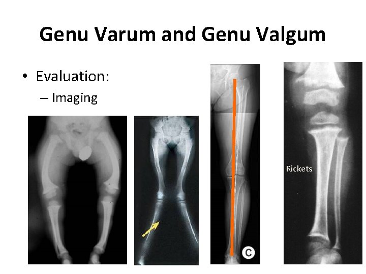 Genu Varum and Genu Valgum • Evaluation: – Imaging Rickets 