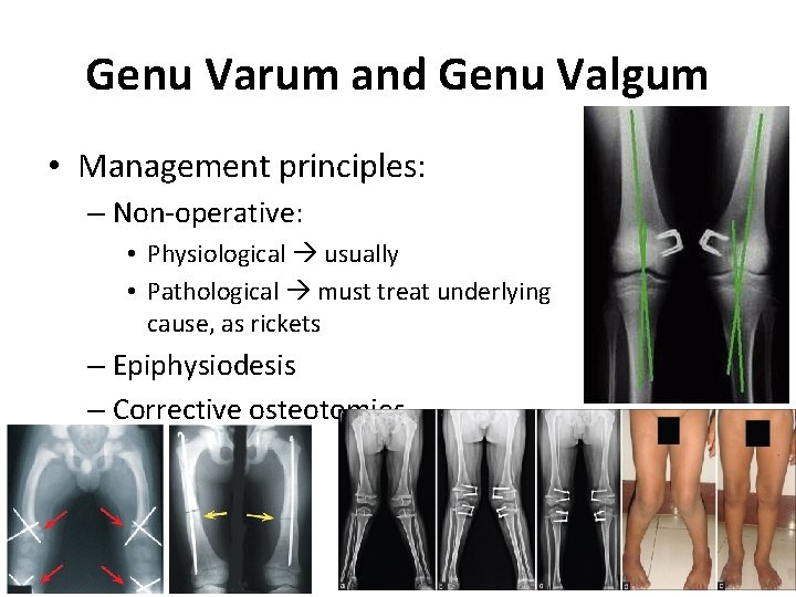 Genu Varum and Genu Valgum • Management principles: – Non-operative: • Physiological usually •