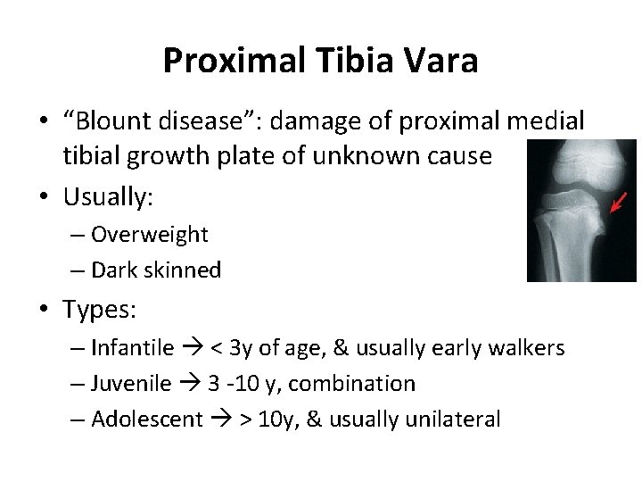 Proximal Tibia Vara • “Blount disease”: damage of proximal medial tibial growth plate of