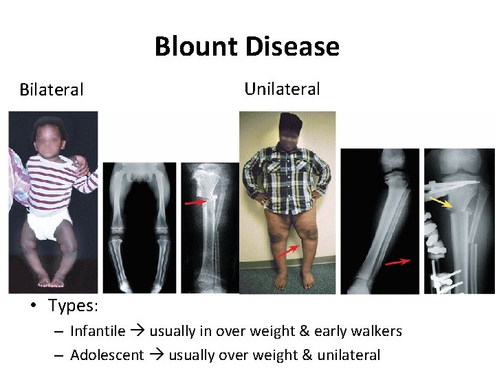 Blount Disease Bilateral Unilateral • Types: – Infantile usually in over weight & early