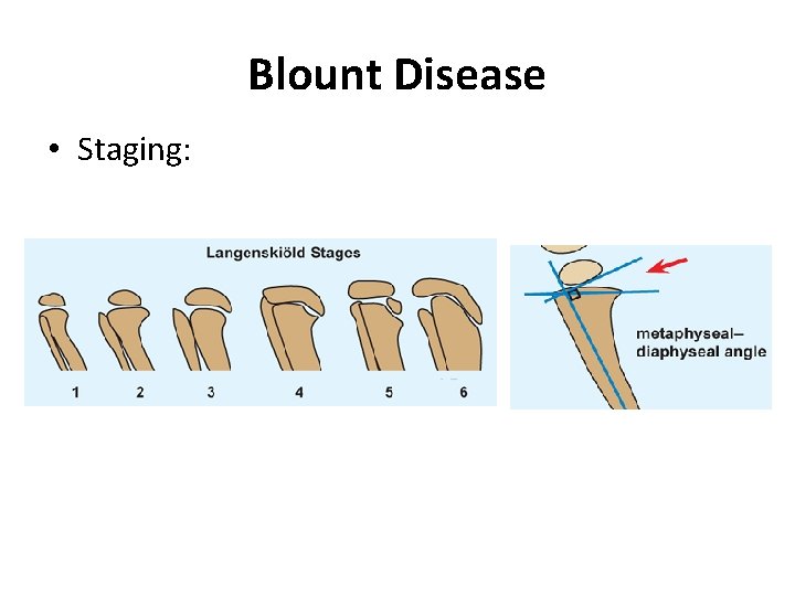 Blount Disease • Staging: 