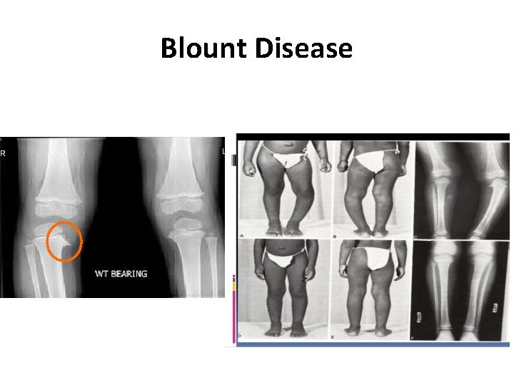 Blount Disease 