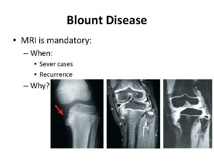 Blount Disease • MRI is mandatory: – When: • Sever cases • Recurrence –