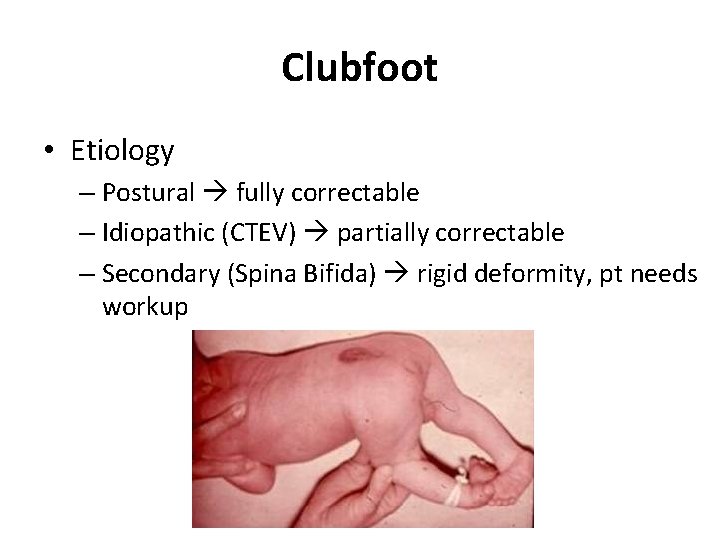 Clubfoot • Etiology – Postural fully correctable – Idiopathic (CTEV) partially correctable – Secondary