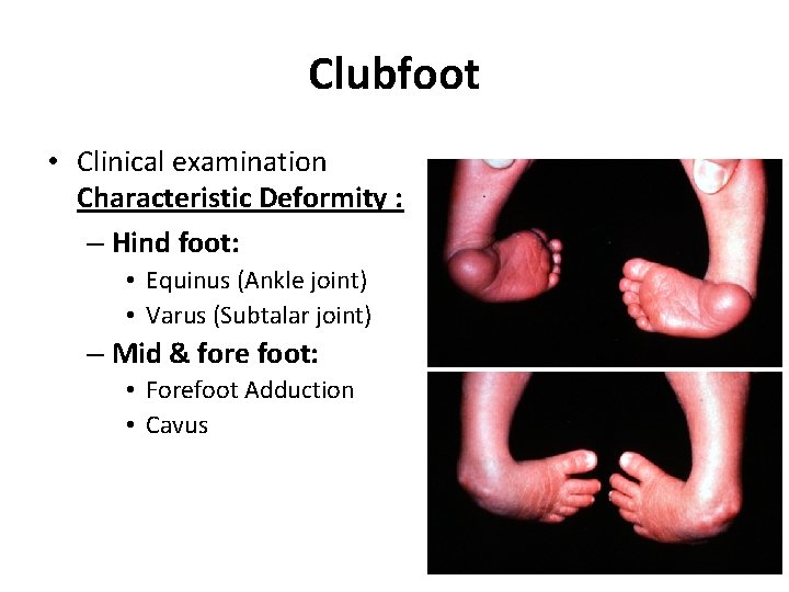 Clubfoot • Clinical examination Characteristic Deformity : – Hind foot: • Equinus (Ankle joint)