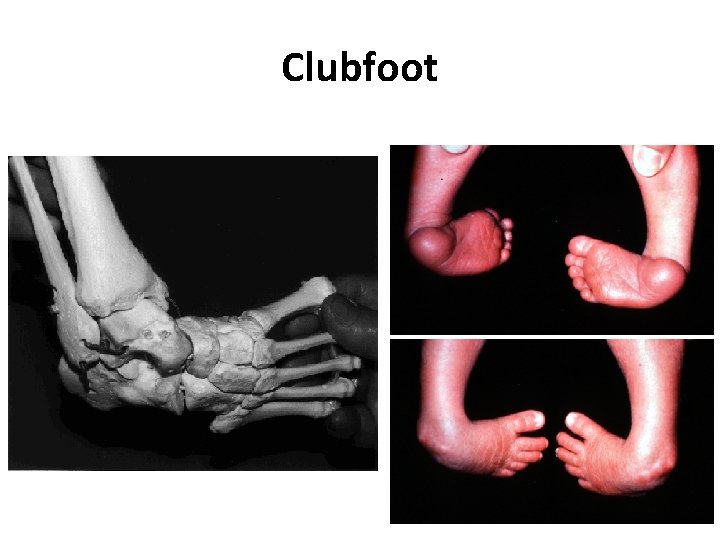 Clubfoot 