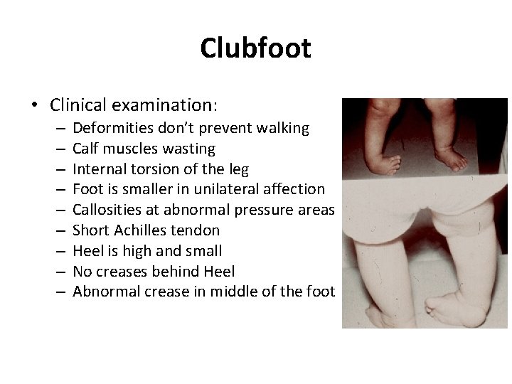 Clubfoot • Clinical examination: – – – – – Deformities don’t prevent walking Calf