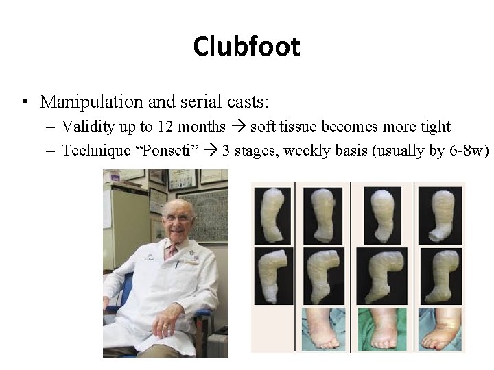 Clubfoot • Manipulation and serial casts: – Validity up to 12 months soft tissue