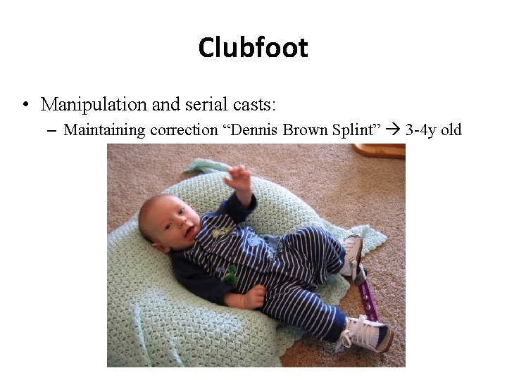 Clubfoot • Manipulation and serial casts: – Maintaining correction “Dennis Brown Splint” 3 -4