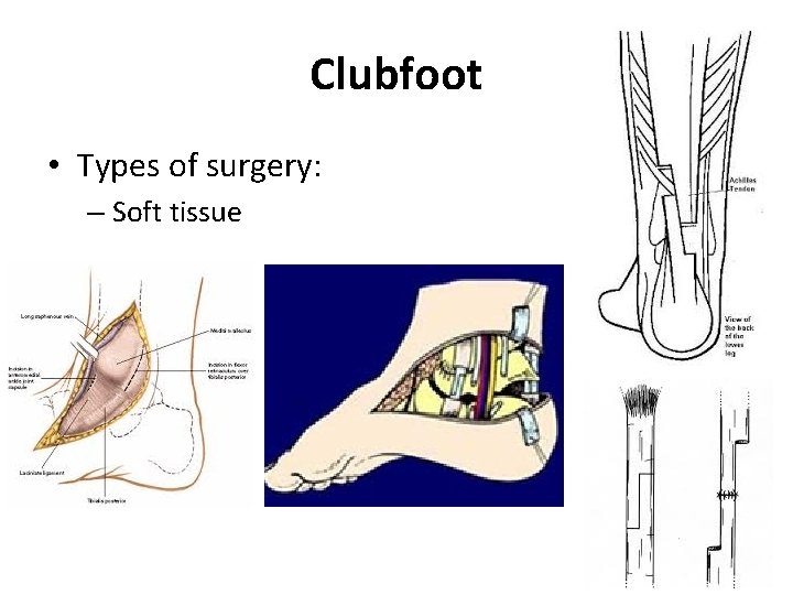 Clubfoot • Types of surgery: – Soft tissue 
