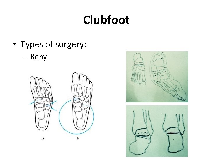 Clubfoot • Types of surgery: – Bony 