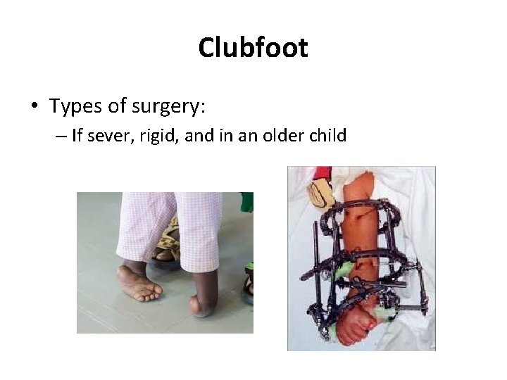 Clubfoot • Types of surgery: – If sever, rigid, and in an older child