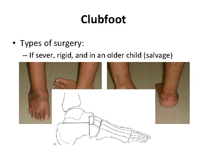 Clubfoot • Types of surgery: – If sever, rigid, and in an older child