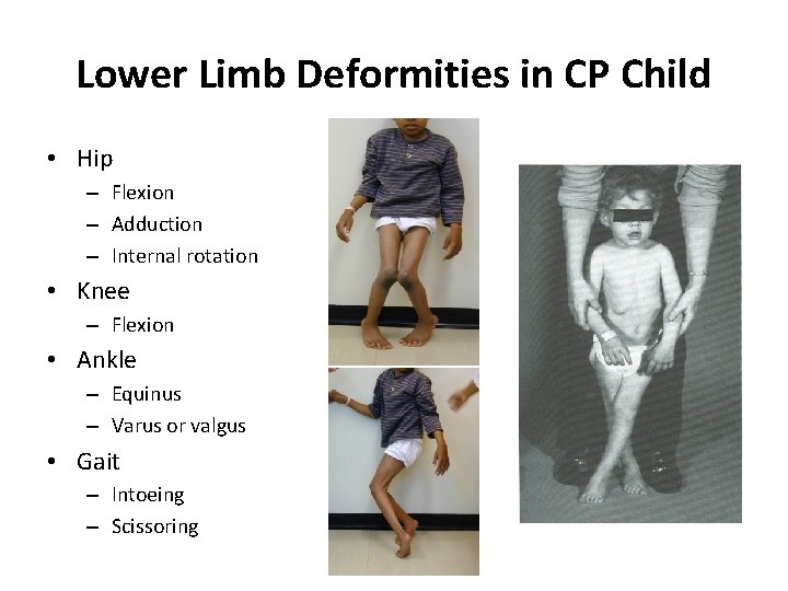 Lower Limb Deformities in CP Child • Hip – Flexion – Adduction – Internal