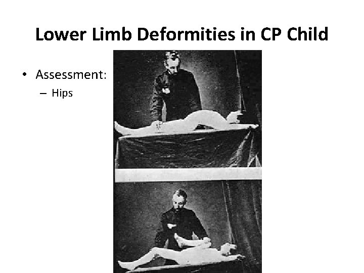 Lower Limb Deformities in CP Child • Assessment: – Hips 