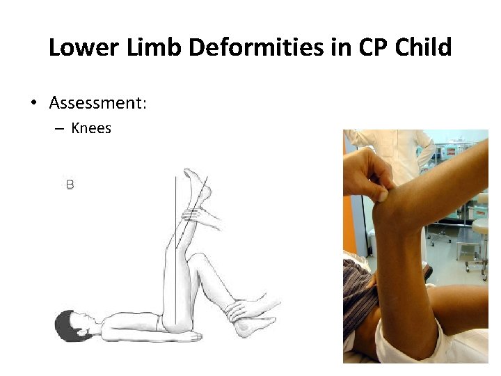 Lower Limb Deformities in CP Child • Assessment: – Knees 