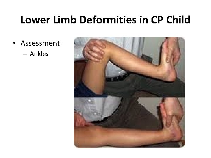 Lower Limb Deformities in CP Child • Assessment: – Ankles 