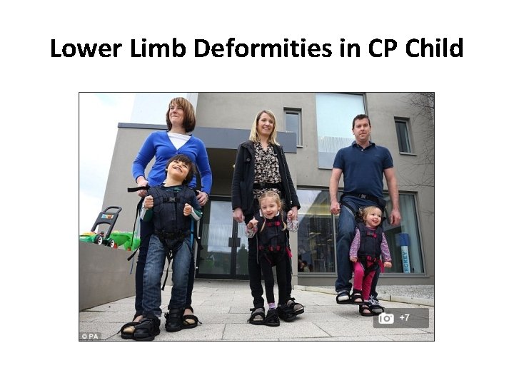 Lower Limb Deformities in CP Child 