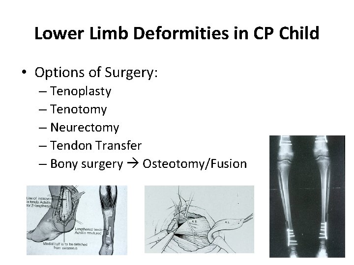Lower Limb Deformities in CP Child • Options of Surgery: – Tenoplasty – Tenotomy