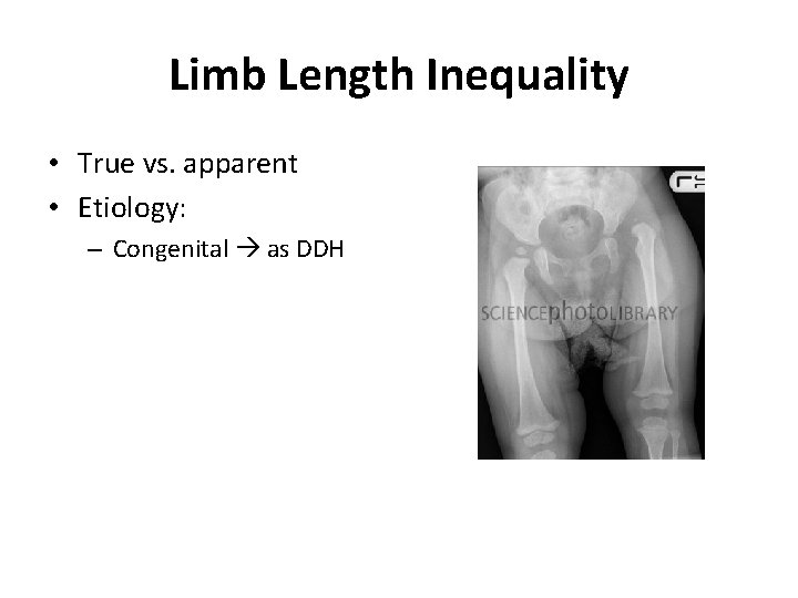 Limb Length Inequality • True vs. apparent • Etiology: – Congenital as DDH 