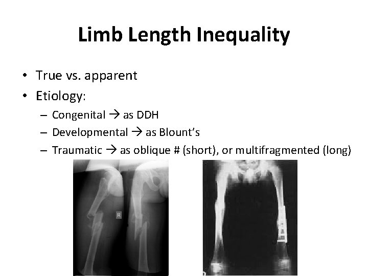 Limb Length Inequality • True vs. apparent • Etiology: – Congenital as DDH –