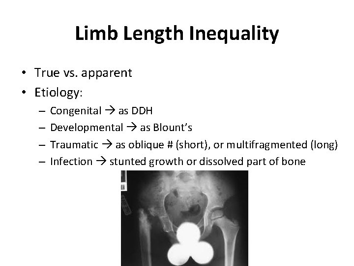 Limb Length Inequality • True vs. apparent • Etiology: – – Congenital as DDH