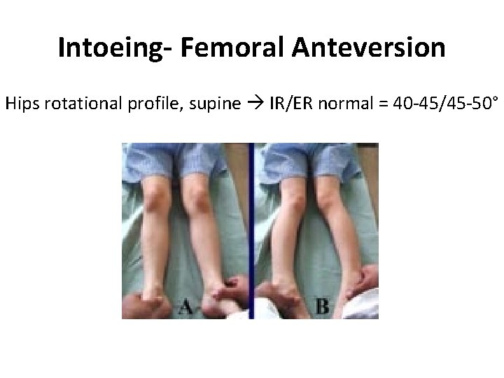 Intoeing- Femoral Anteversion Hips rotational profile, supine IR/ER normal = 40 -45/45 -50° 