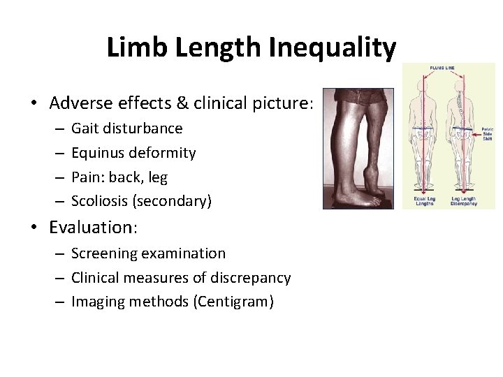 Limb Length Inequality • Adverse effects & clinical picture: – – Gait disturbance Equinus