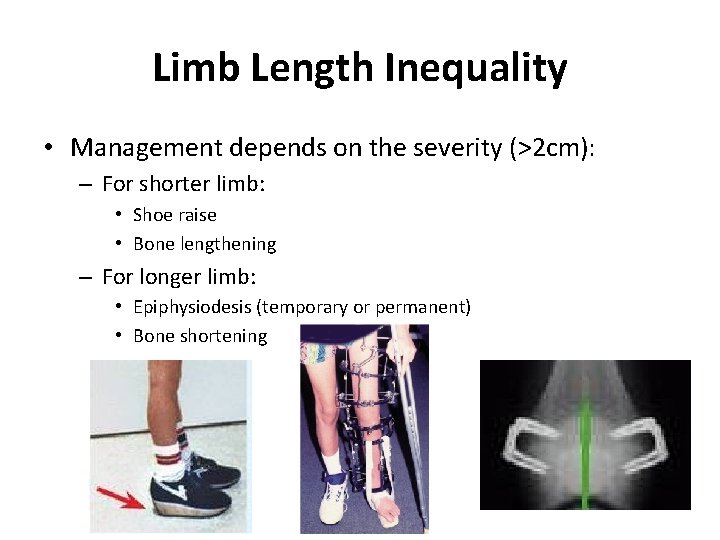Limb Length Inequality • Management depends on the severity (>2 cm): – For shorter