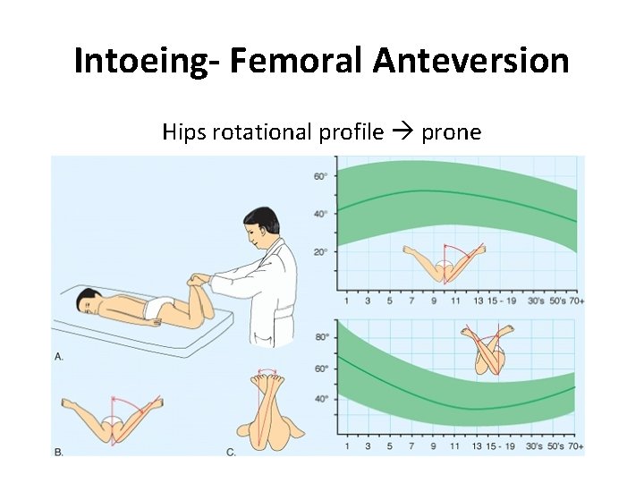 Intoeing- Femoral Anteversion Hips rotational profile prone 