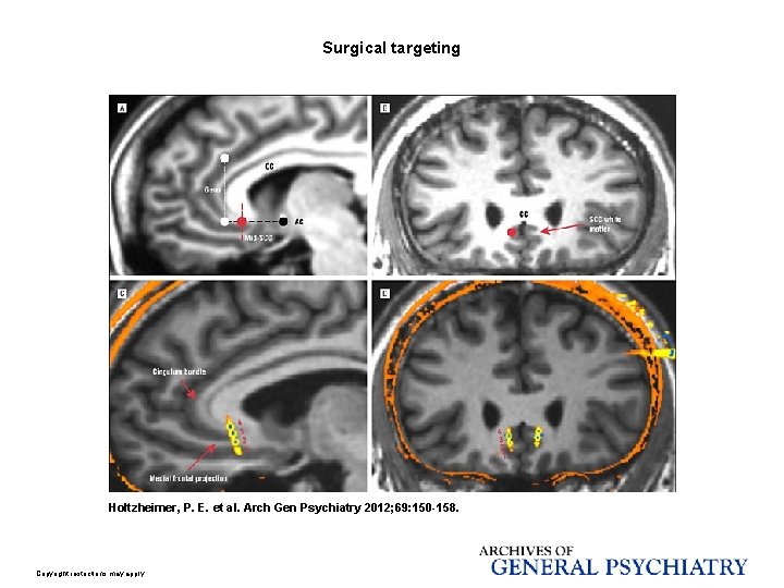 Surgical targeting Holtzheimer, P. E. et al. Arch Gen Psychiatry 2012; 69: 150 -158.