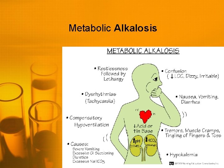 Metabolic Alkalosis 