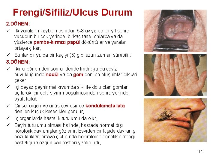 Frengi/Sifiliz/Ulcus Durum 2. DÖNEM; ü İlk yaraların kaybolmasından 6 -8 ay ya da bir