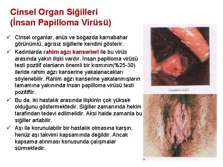 Cinsel Organ Siğilleri (İnsan Papilloma Virüsü) ü Cinsel organlar, anüs ve boğazda karnabahar görünümlü,
