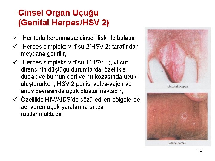 Cinsel Organ Uçuğu (Genital Herpes/HSV 2) ü Her türlü korunmasız cinsel ilişki ile bulaşır,