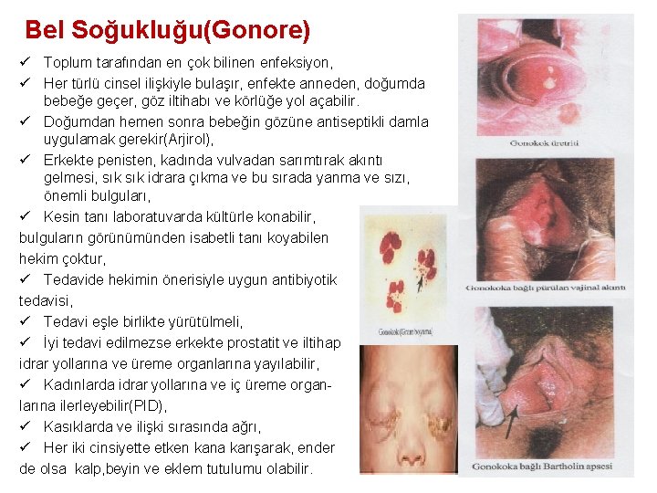 Bel Soğukluğu(Gonore) ü Toplum tarafından en çok bilinen enfeksiyon, ü Her türlü cinsel ilişkiyle