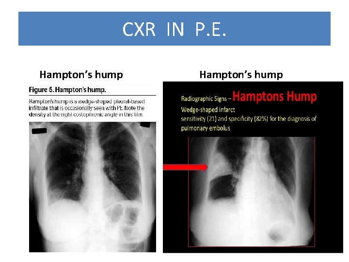 CXR IN P. E. Hampton’s hump 