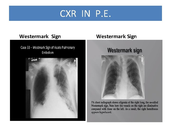 CXR IN P. E. Westermark Sign 