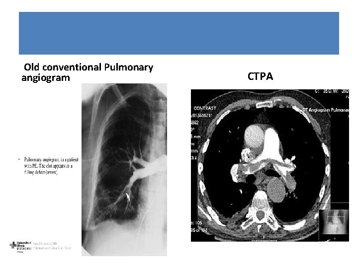 Old conventional Pulmonary angiogram CTPA 