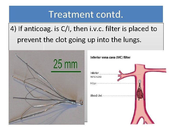 Treatment contd. 4) If anticoag. is C/I, then i. v. c. filter is placed