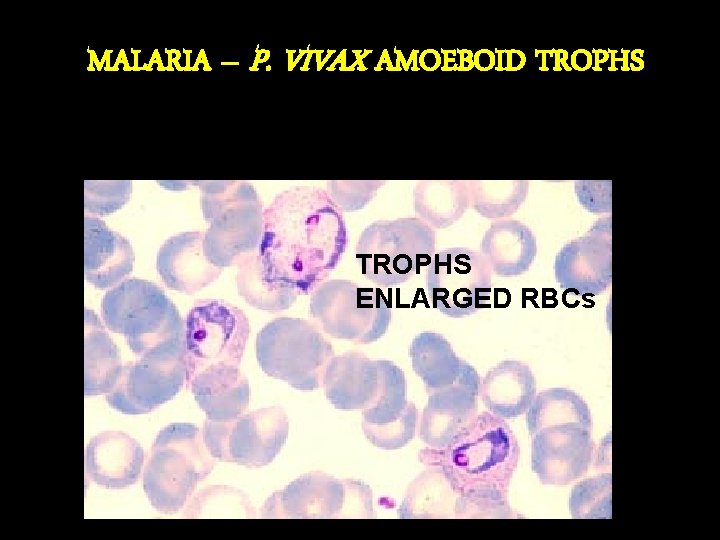 MALARIA – P. VIVAX AMOEBOID TROPHS ENLARGED RBCs 