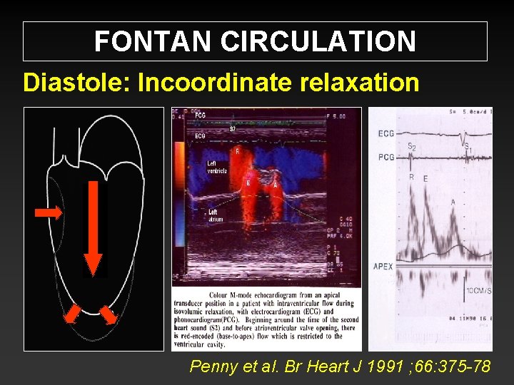 FONTAN CIRCULATION Diastole: Incoordinate relaxation Penny et al. Br Heart J 1991 ; 66: