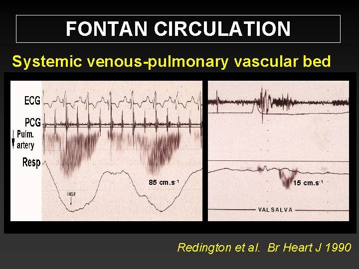 FONTAN CIRCULATION Systemic venous-pulmonary vascular bed 85 cm. s-1 15 cm. s-1 Redington et