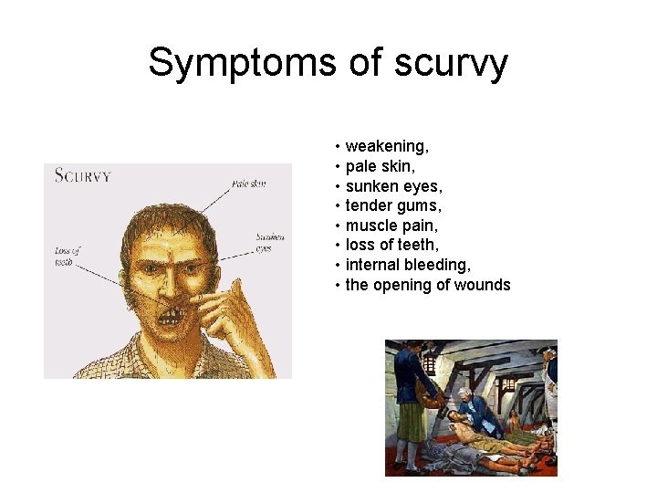 Symptoms of scurvy • weakening, • pale skin, • sunken eyes, • tender gums,