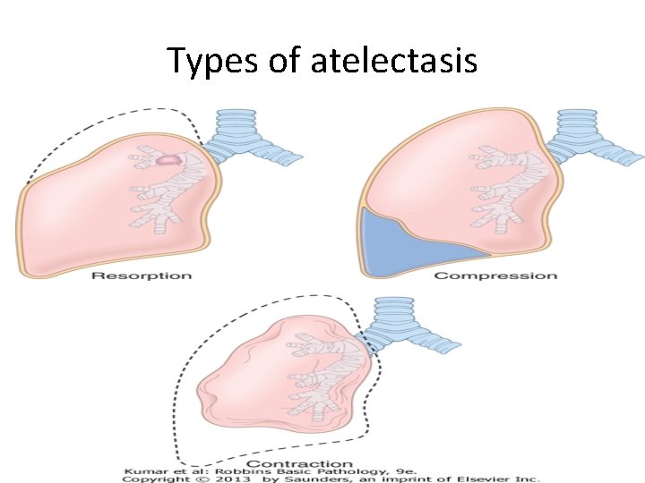 Types of atelectasis 12 