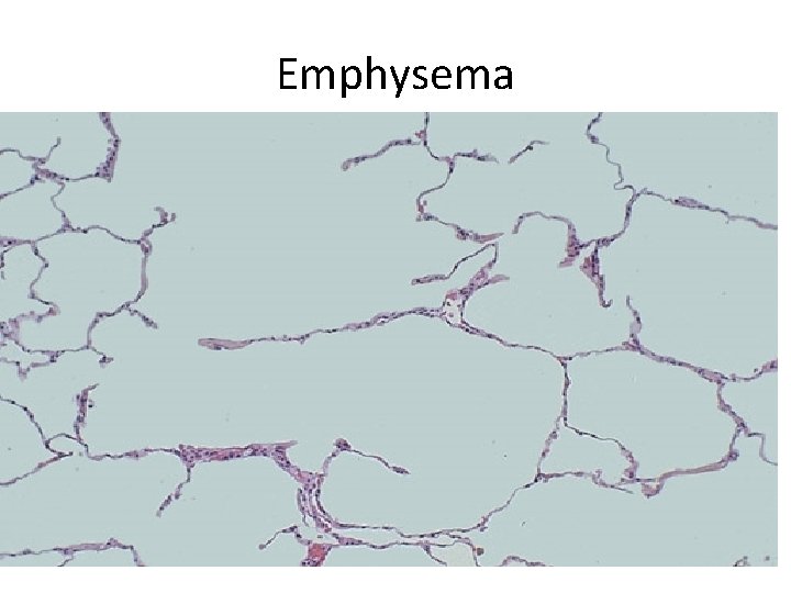 Emphysema 