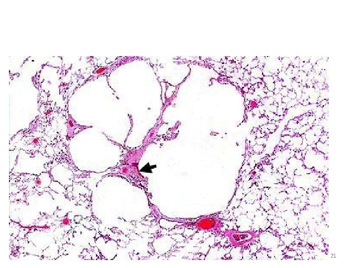 Centriacinar emphysema 21 